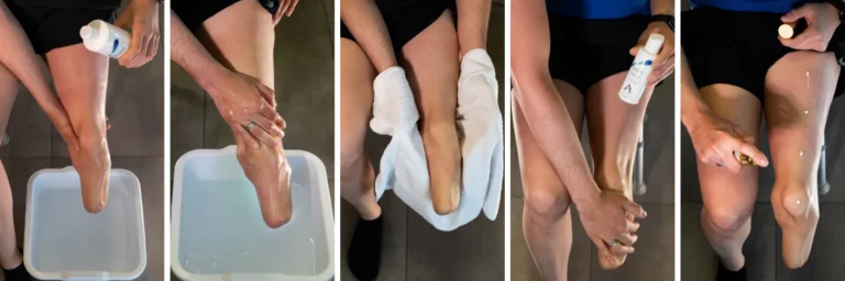 Caring for Yourself: Stump Care After Amputation