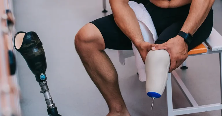 Top Tips for Managing Phantom Limb Pain After Amputation