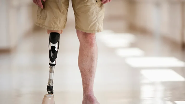 What Does It Feel Like to Lose a Limb? Amputees Share Insights